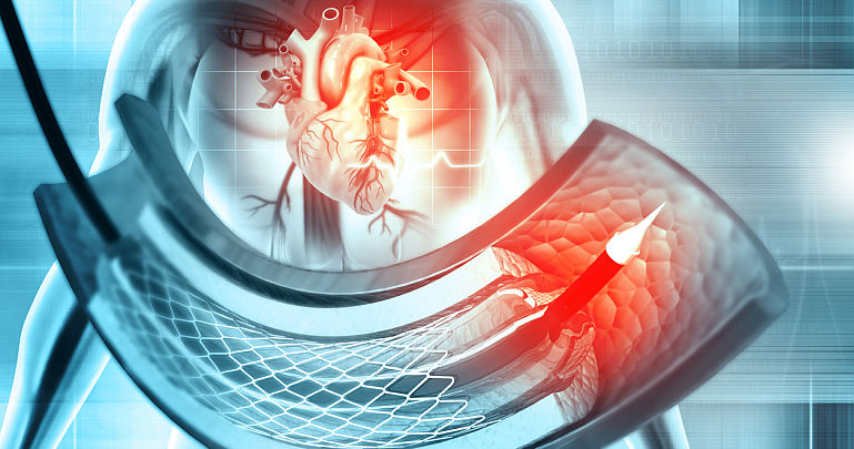 Cauze frecvente ale insuficientei cardiace Cauze frecvente ale insuficientei cardiace