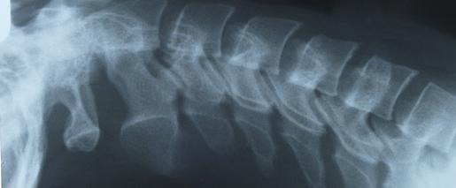 Scleroza multipla