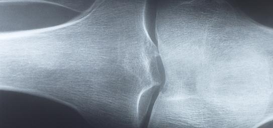 Osteoporoza
