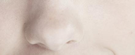 Deviatia de sept si rinoplastia