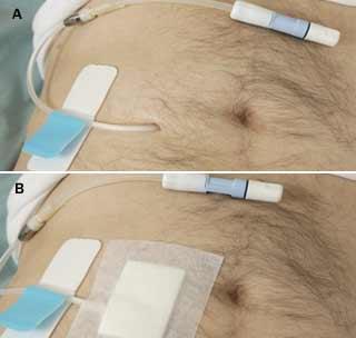 Cateterul pentru dializa peritoneala