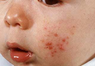 Acneea bebelusului