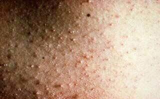 Iritatia de la caldura