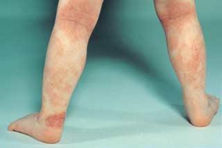 Eczema bebelusului