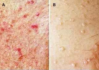 Miliaria (iritatiile de la caldura)