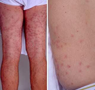 Iritatiile inotatorilor