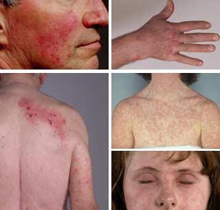 Nu este intotdeauna grava, dar uneori provoaca dureri