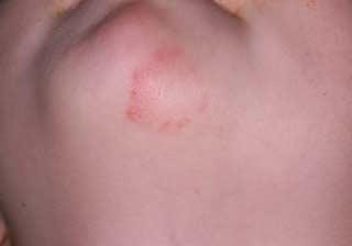 Tinea corporis (Impetigo)