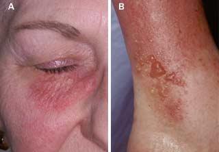 Dermatita de contact