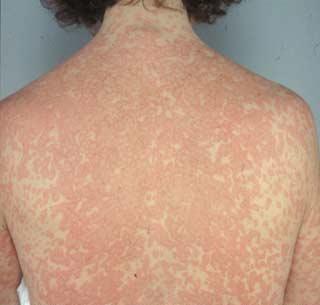 Alergia la medicamene