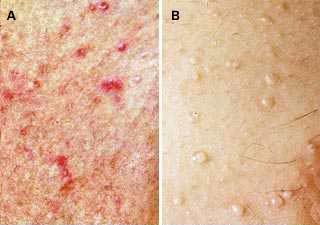 Miliaria (iritatiile de la caldura)