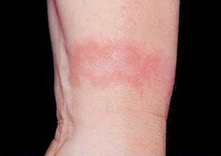 Dermatita de contact iritanta