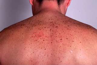 Lentiginele solare pe spate