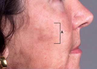 Melasma