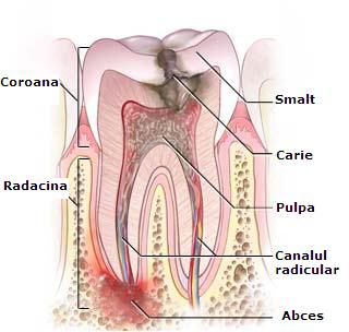 De ce aveti nevoie de un canal radicular