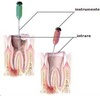 Inceperea tratamentului de canal