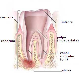 Tratarea infectiei canalului radicular