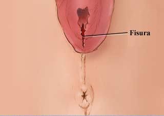 Rupturi de gradul intai