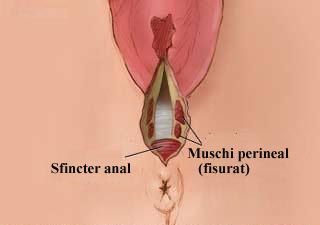 Rupturi de gradul doi