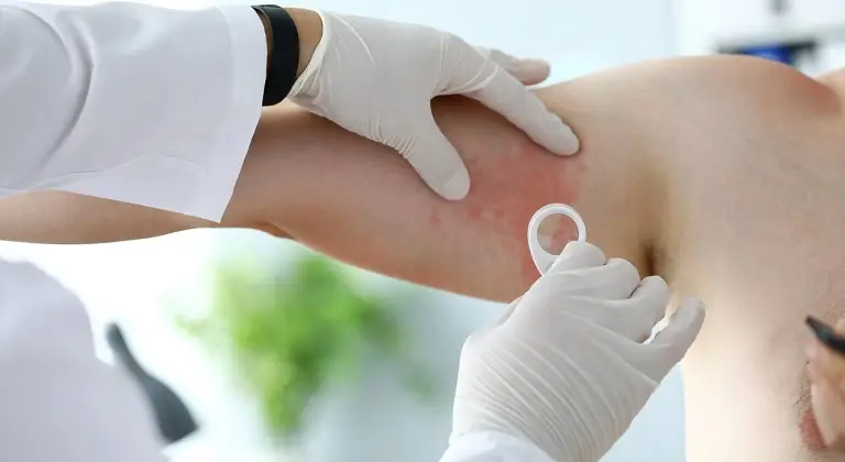 Angiomatoza bacilara, infectie bacteriana frecvent intalnita la varstnici