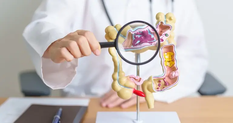 Lucruri pe care trebuie sa le stii despre depistarea precoce a cancerului colorectal