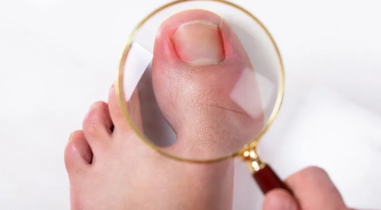 Pasi importanti pentru refacerea unghiilor cu micoza