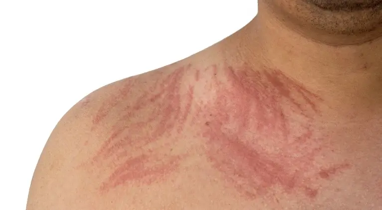Dermatografia - cauze, simptome, tratament
