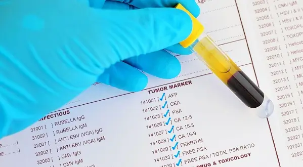 Diagnosticul cancerului testicular, simplificat cu ajutorul unui test de sange