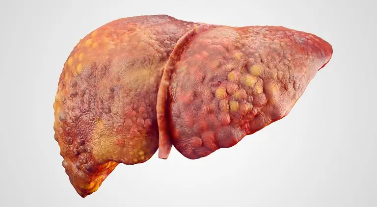 Afectiunile hepatice si impactul consumului crescut de grasimi