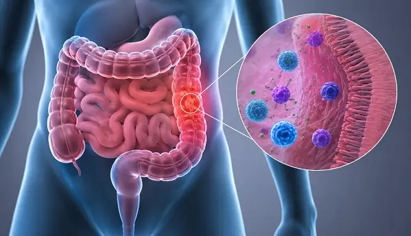De ce unele tratamente pentru inflamatia intestinala nu functioneaza
