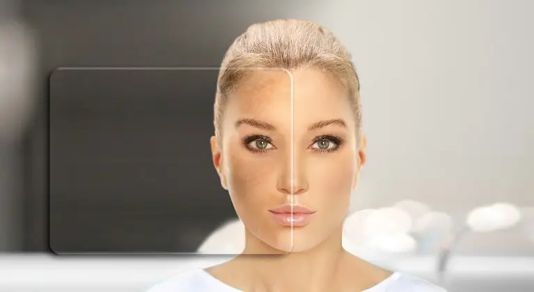 Melasma - cauze, tratament si prevenire