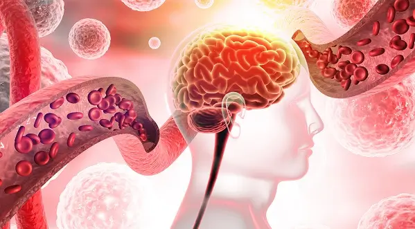 Microangiopatiile cerebrale cresc riscul de accident vascular