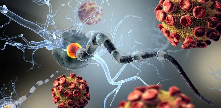 Neurosifilisul, o complicatie a infectiei cu Treponema pallidum