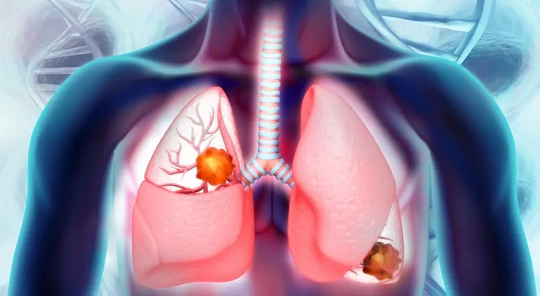 Nodulii pulmonari nu inseamna automat cancer – iata ce trebuie sa stii