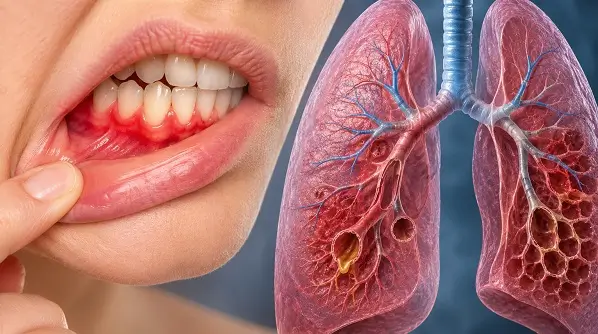 Inflamatia gingiilor, asociata cu risc pulmonar crescut