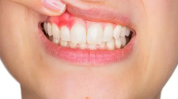 De ce sunt atat de dificil de tratat infectiile orale?