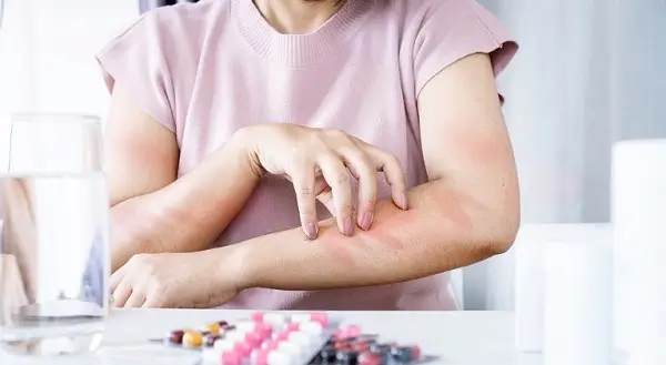 Dermatita atopica si legatura cu alergiile: ghid complet