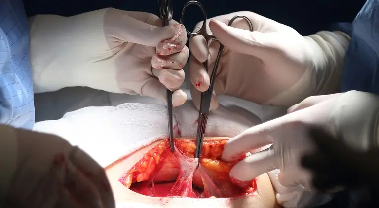 Splenectomia sau indepartarea splinei - cand si de ce este recomandata