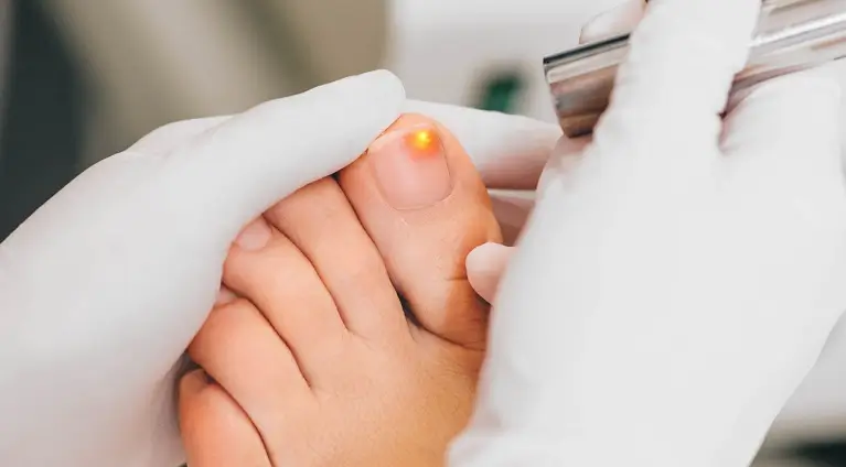 Cum putem vindeca infectiile fungice ale unghiilor