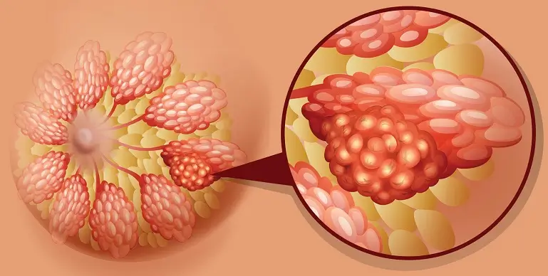 Densitatea mamara crescuta: semnificatii