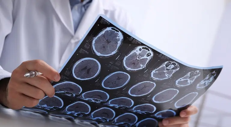 Tumorile sistemului nervos central - De la diagnostic la tratament