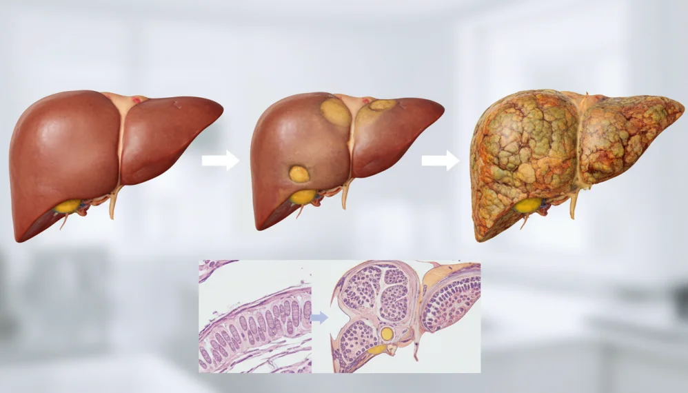 Ciroza hepatica