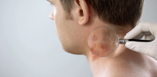 Poate dermatita seboreica sa provoace caderea parului?