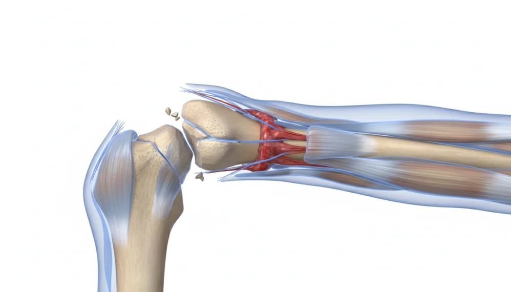 Fractura de femur