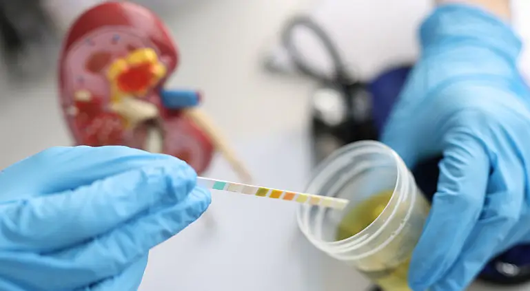 Hematuria - prezenta sangelui in urina