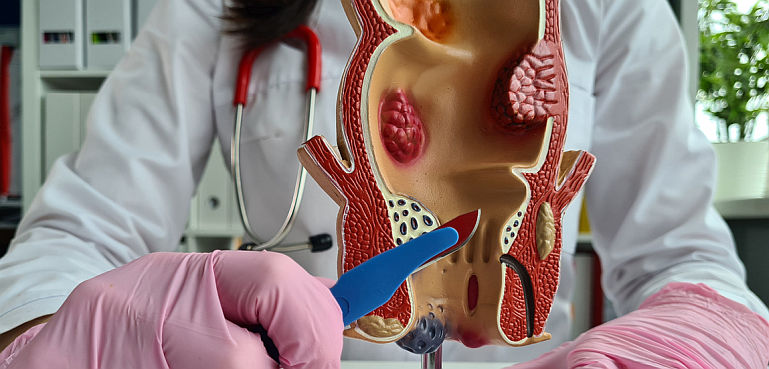 Hemoroizi sau cancer?