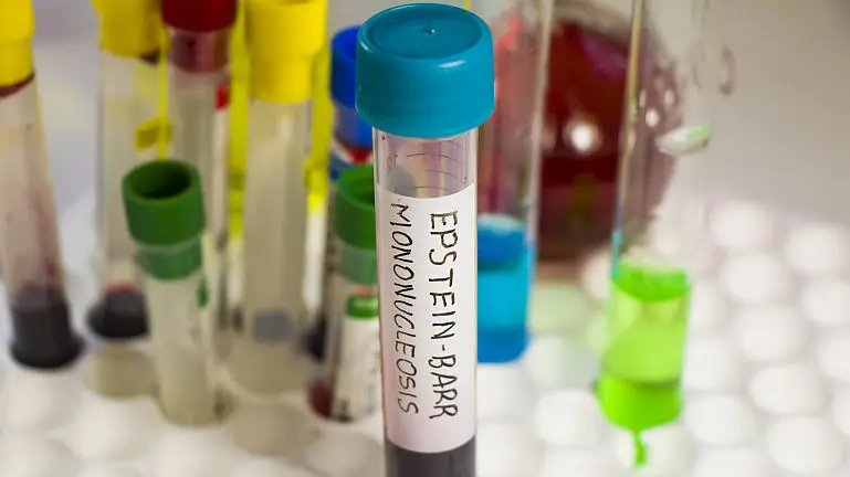 Mononucleoza infectioasa cu virus Epstein Barr