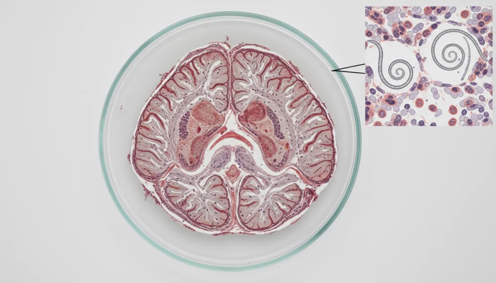 Neurosifilis sau sifilis cerebral