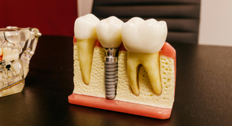 Reabilitarea completa a danturii pe implanturi: ce presupun procedurile All-on-4 si All-on-6