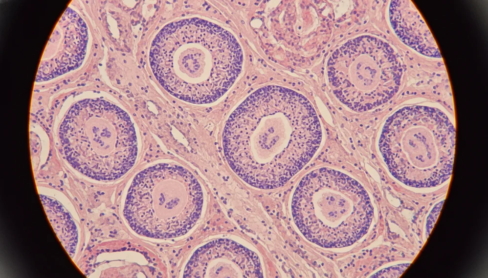 Sindromul granulomatos cronic
